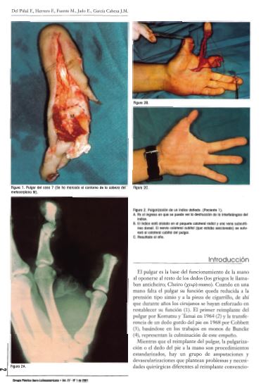 Replantation of the thumb