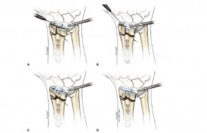 Treatment of Explosion-Type Distal Radius Fractures