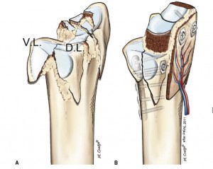 Sigmoid cavity reconstruction by osteotomy