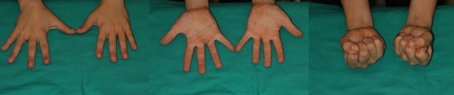 Postoperative situation (10 years later), previous case