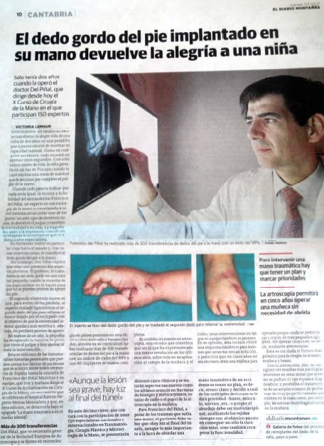 "El dedo del gordo del pie implantado en su mano devuelve la alegría a un niña"