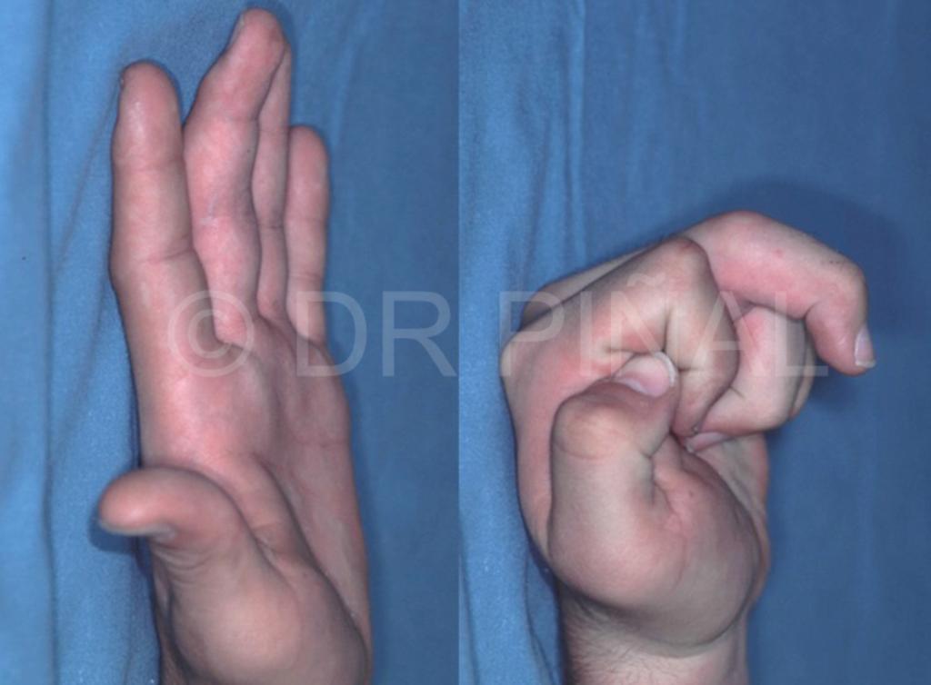 Situación preoperatoria (1). Pasados tres meses de la fractura luxación en la interfalángica proximal, la pérdida de rango de movimiento de la articulación es notable.