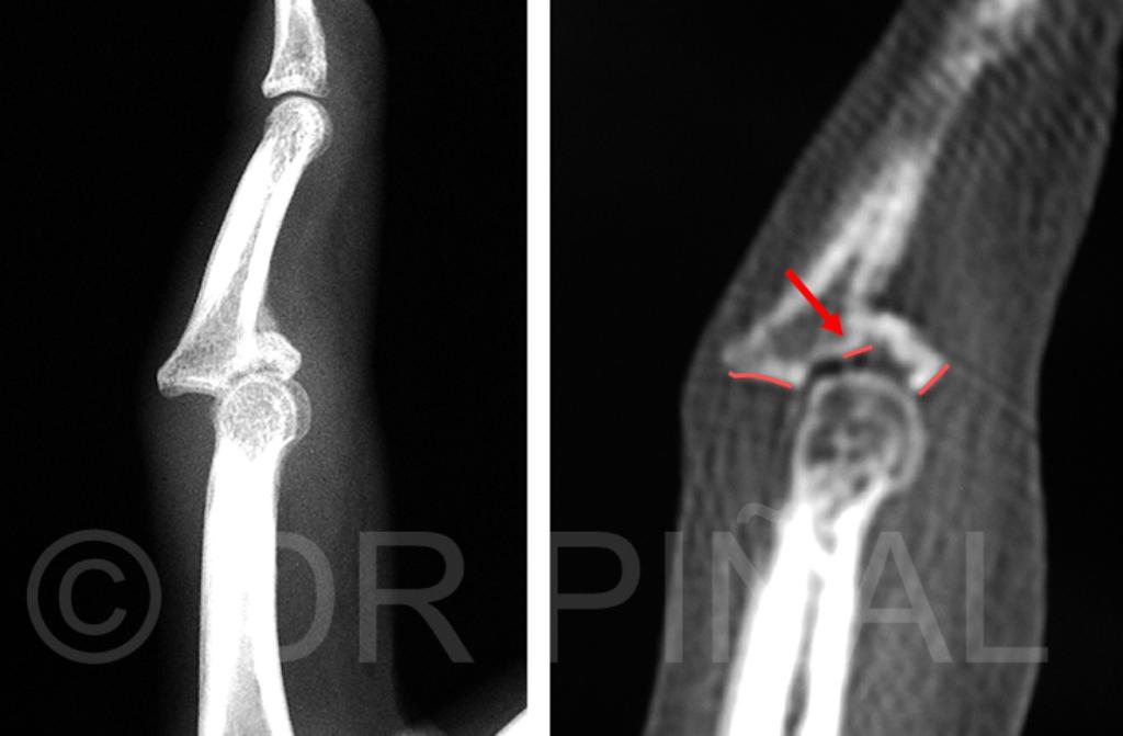 Situación preoperatoria (2). En la imagen del escáner se aprecian, señalados con una flecha, los fragmentos articulares desplazados. 