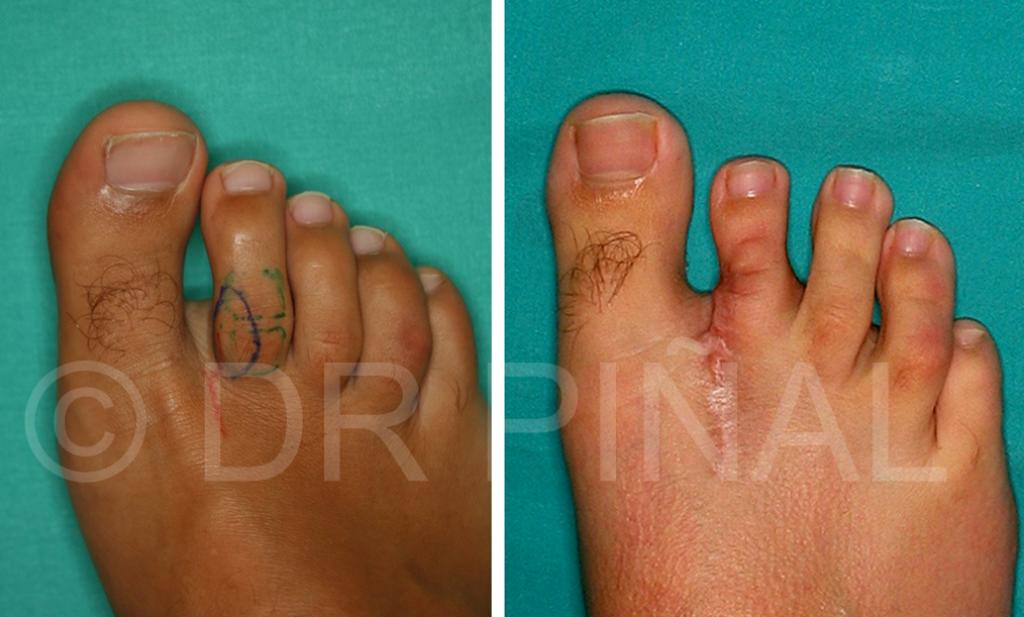 Situación preoperatoria (2). En la imagen, área donante del trasplante articular. En el procedimiento se salvaguardan la movilidad y estética tanto de mano como de pie donante.