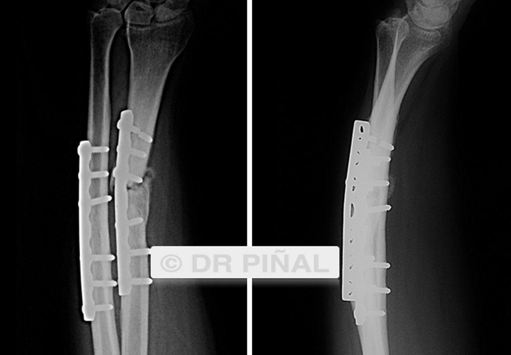 Situación preoperatoria. En la imagen puede apreciarse la no consolidación de la fractura de radio. Incluso se aprecia la rotura de parte de los tornillos quirúrgicos insertados.