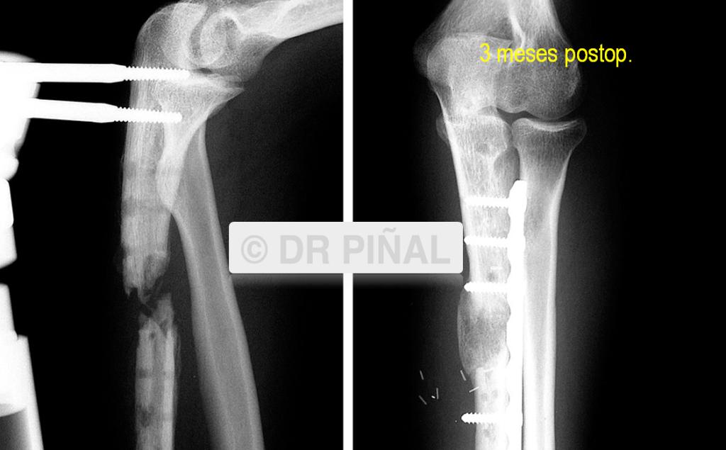Recuperación de paciente con malunión y osteomieltis de cubito a los tres meses
