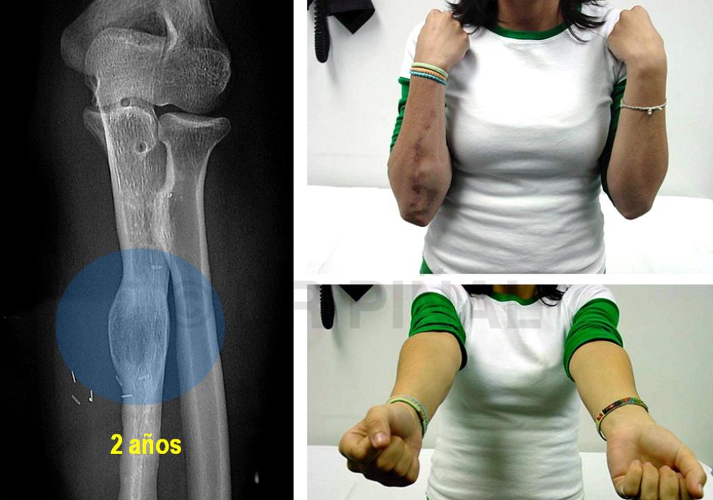 Recuperación de paciente con malunión y osteomieltis de cubito a los dos años