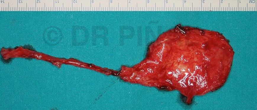Vista del periostio ya extraído en la que se aprecia su tamaño y la parte vascular a ‘reconectar’ mediante microcirugía.