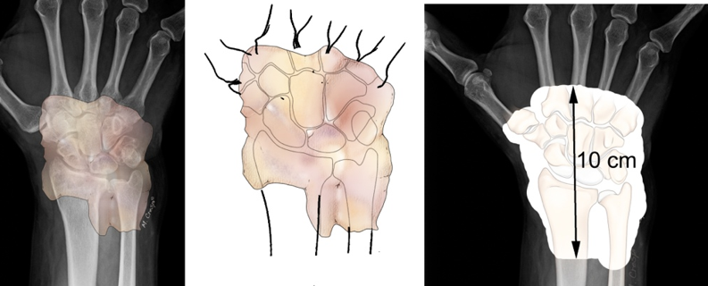 Tumor muñeca_20170129_01