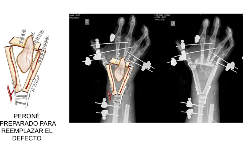 Tumor muñeca_20170129_06