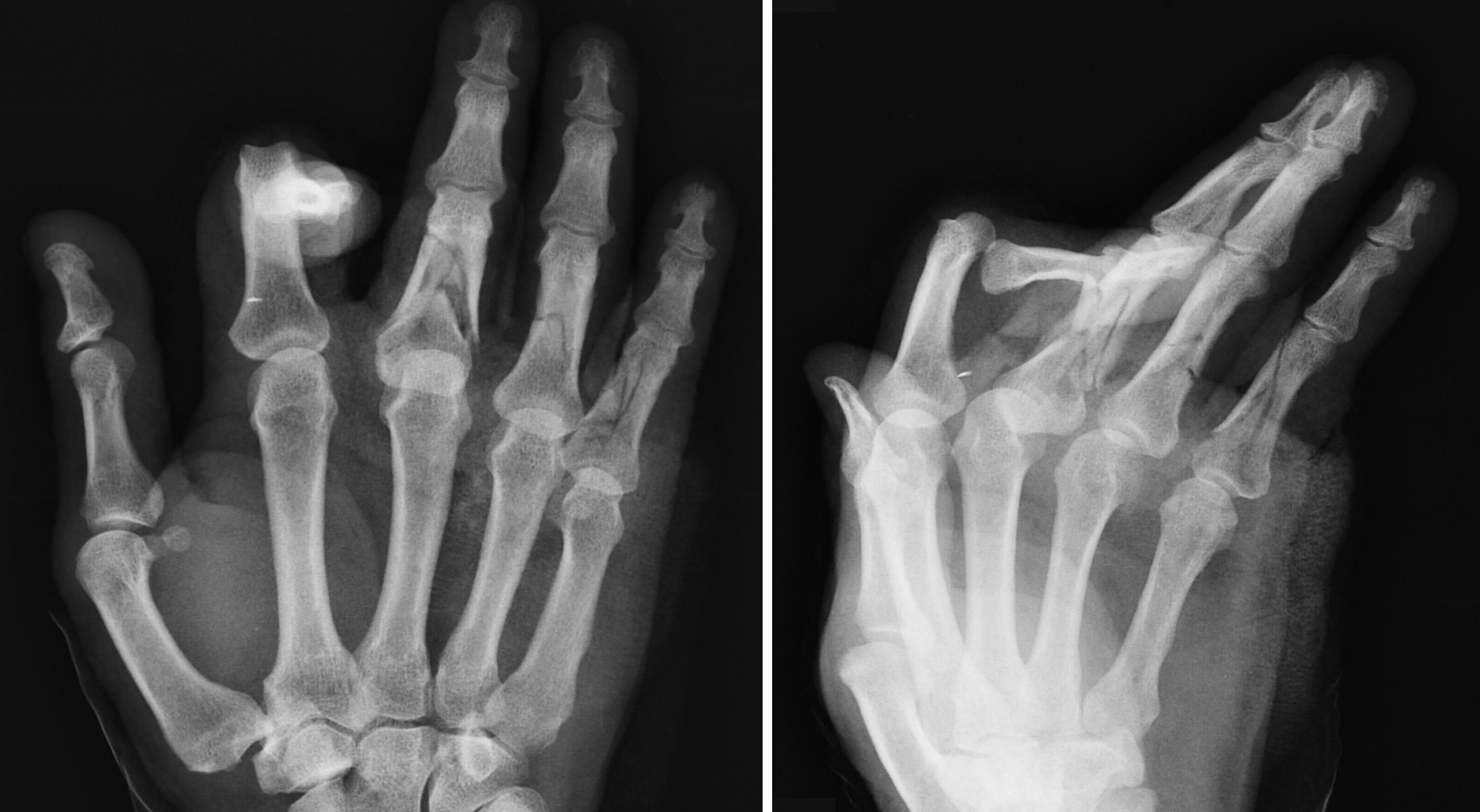 Radiographic images of the patient's comminuted fractures
