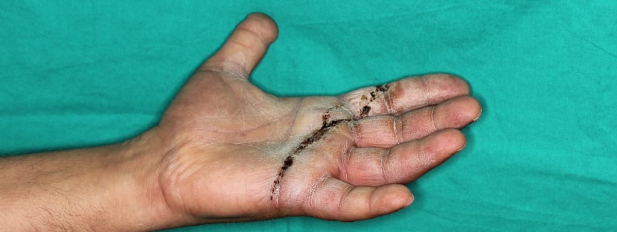 Wounds by crushing and mobility a week after the intervention of Dr. Piñal