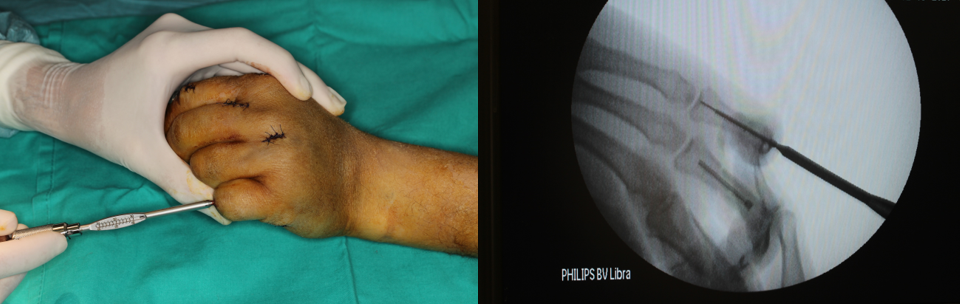 Insertion of cannulated screw in the fifth finger of the left hand