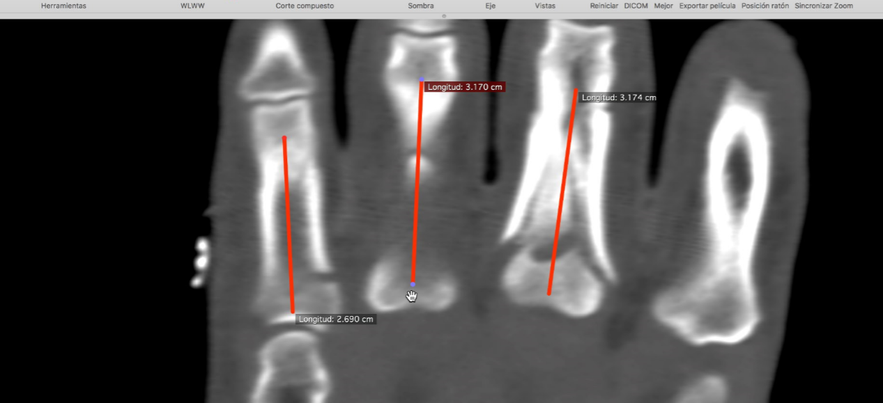 Measurement for cannulated screws 