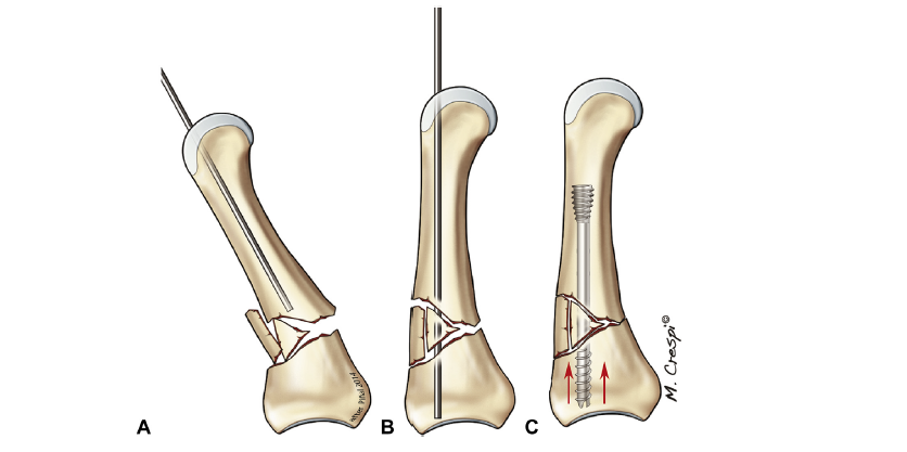 Idealization of the technique of axial strutting