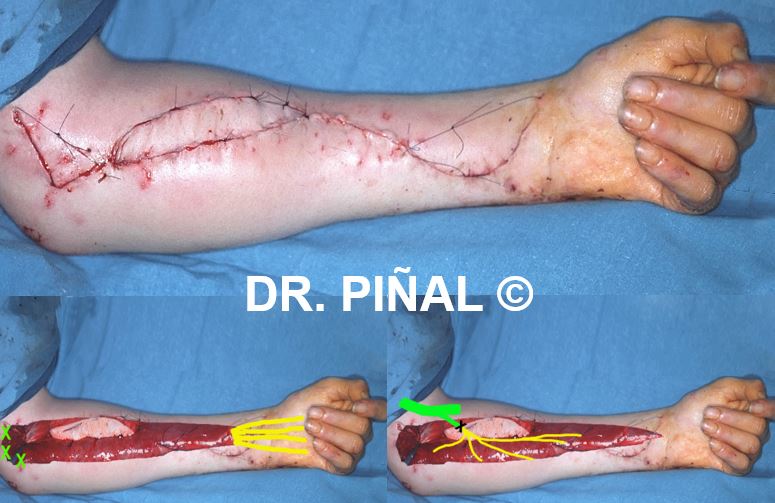 Reconexión nerviotendinosa y vascular del recto interno o gracilis