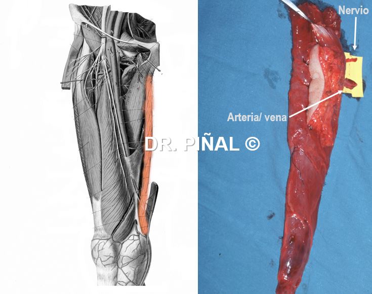 Músculo gracilis preparado para transferencia microquirúrgica 