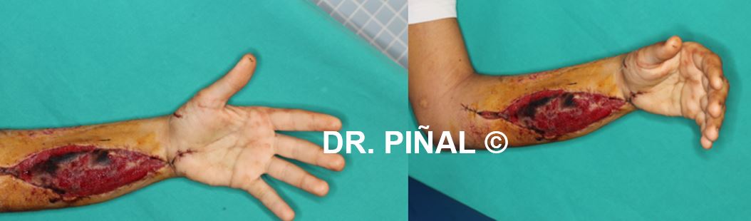 Daño muscular con riesgo de sepsis
