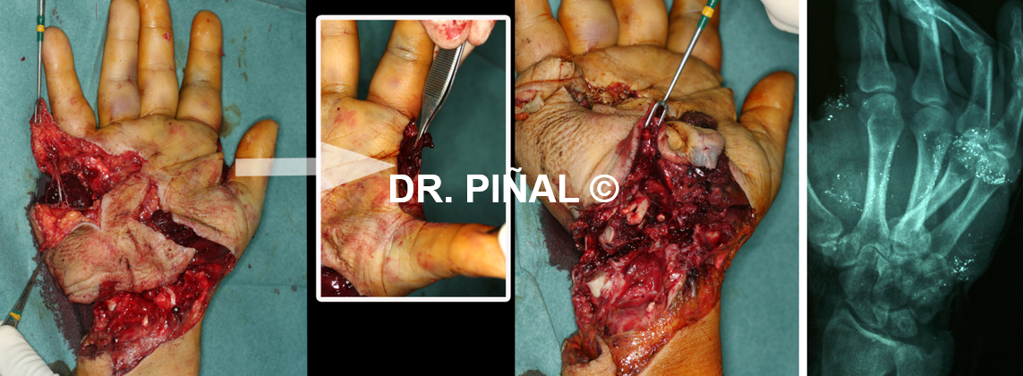 Loss of muscle mass in the hand and sectioned wrist