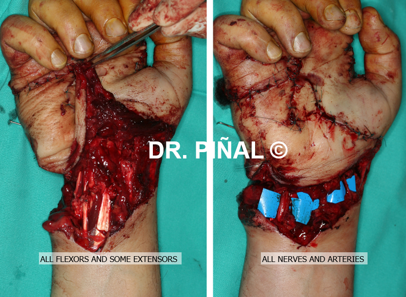 Microsurgical reconnection of tendons, nerves and blood vessels