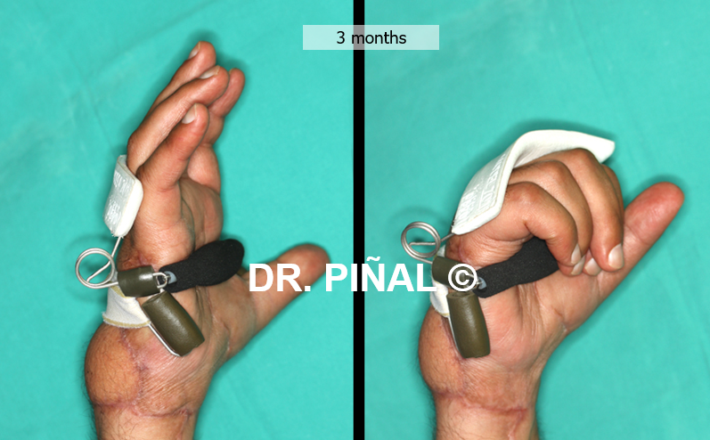 The 'anti-claw' splint prevents fixed stiffness of the hand