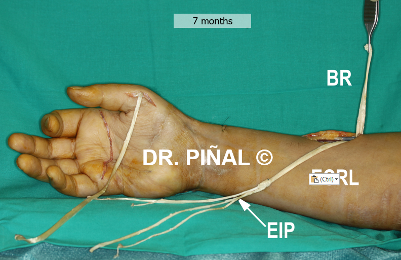 Reconnection and variation of muscle-tendinous functions