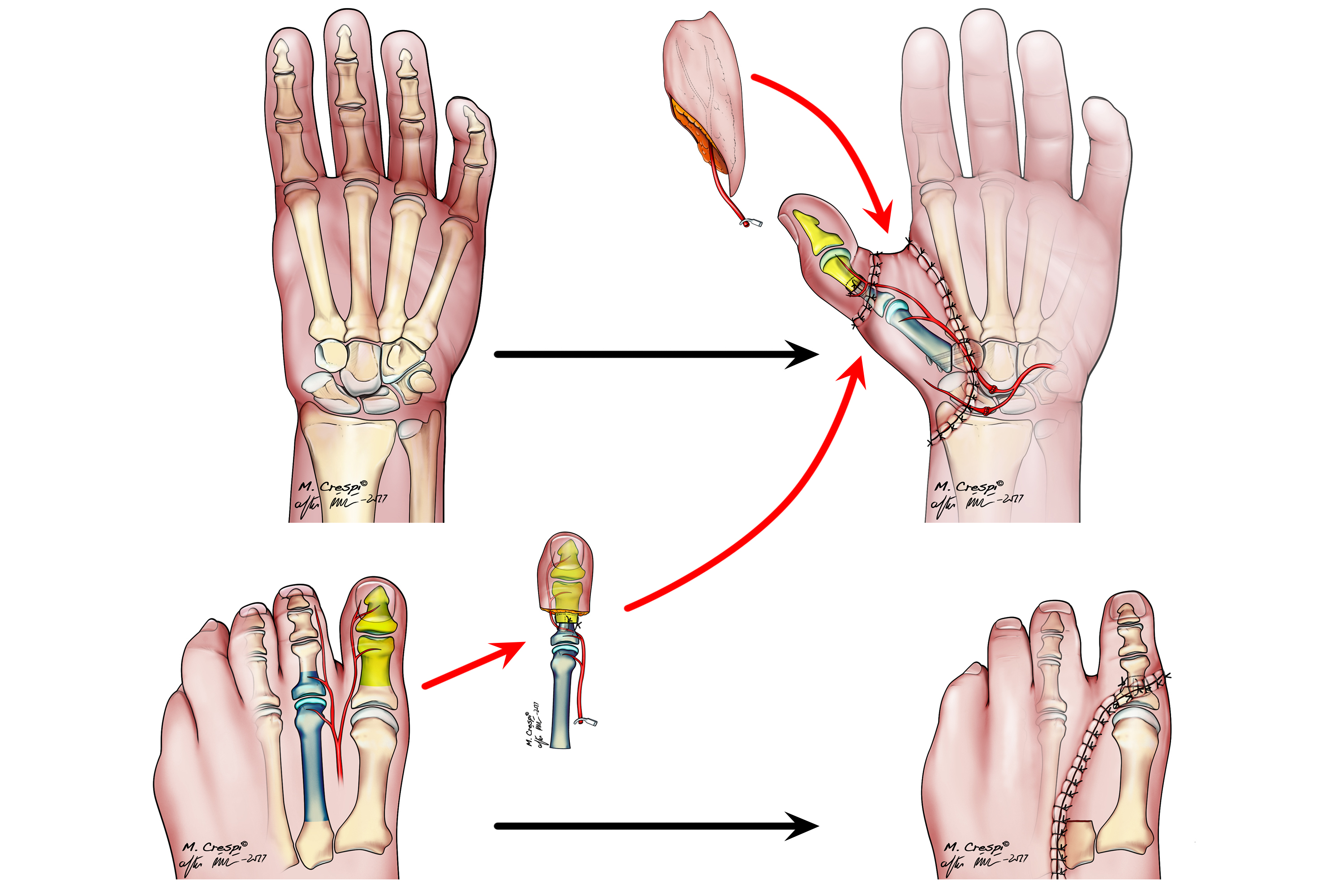 Design of the surgical procedure, pioneer in Spain