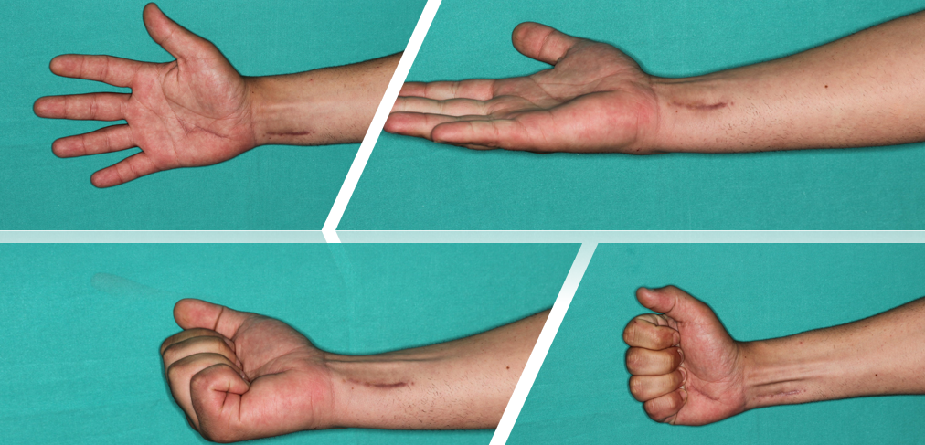 Aesthetic-functional recovery after the intervention