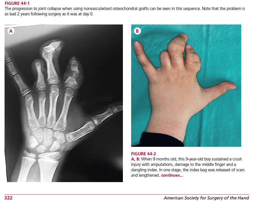 Vascularized Joint and Hemi-Joint Flap
