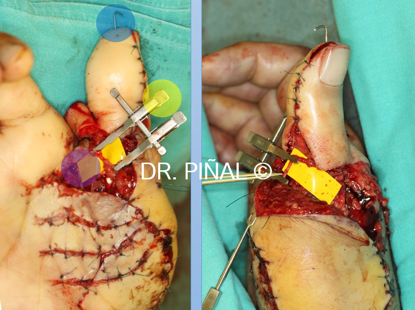 Some of the main details of the surgical procedure