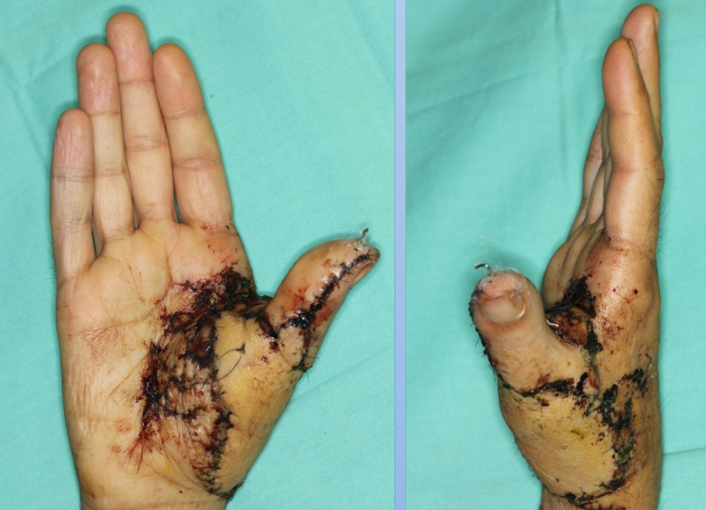 Postoperative results after 15 days