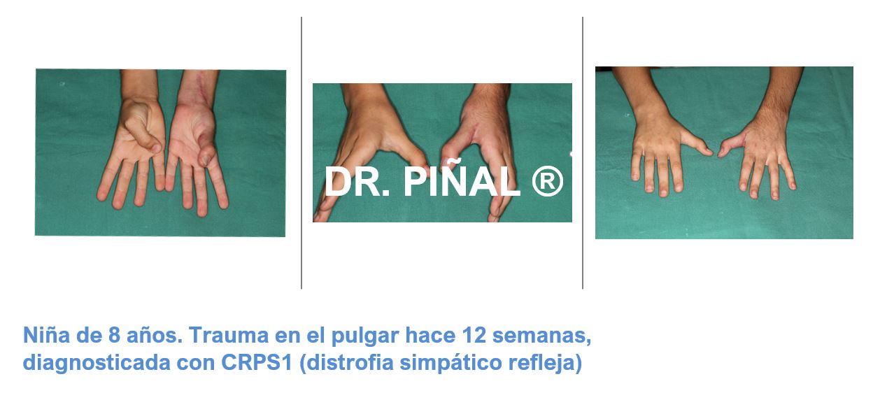 Injerto de colgajo neurocutáneo_CRPS_02_20190527