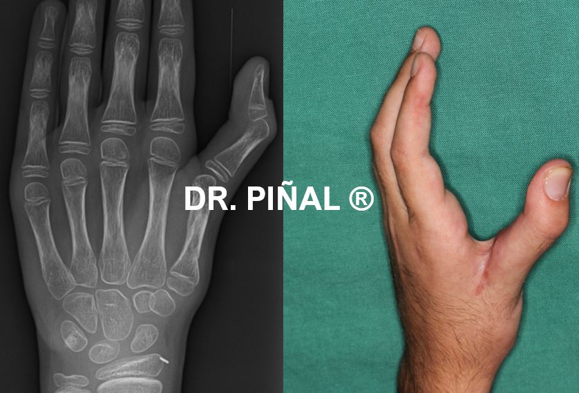 Hiperextensión de la articulación metacarpofalángica