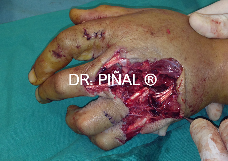 Multiple crush fractures