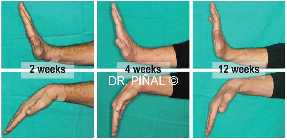 Evolution of flexion-extension movement