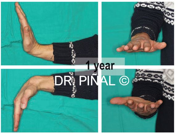 Result at one year