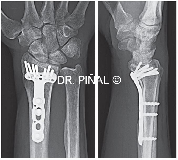 Final radiographs