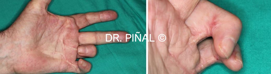 Typical picture of Dupuytren's disease