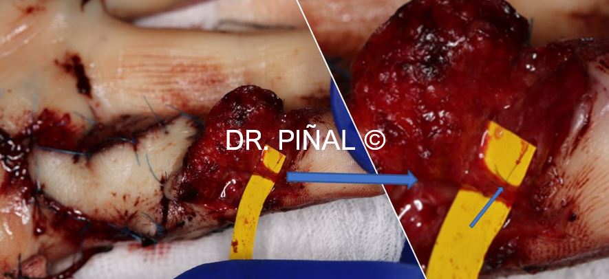 Vascularized neurocutaneous free flap