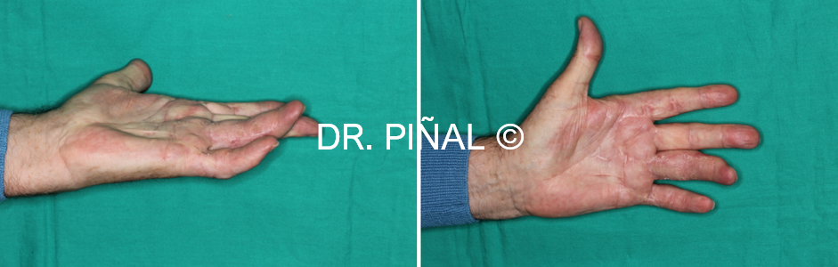 Postoperative results