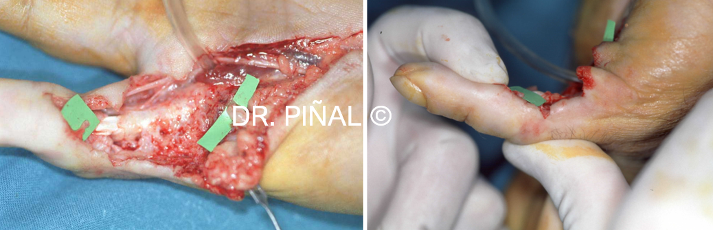 Neurocutaneous defect 
