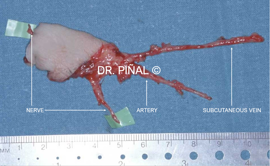 Vascularized neurocutaneous free flap
