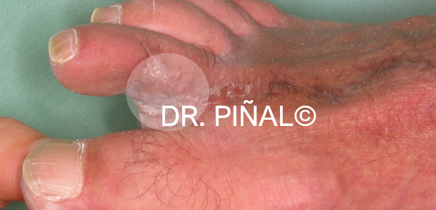Postoperative view of the donor area 