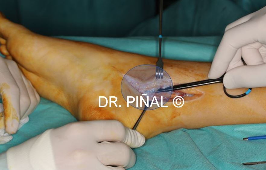 Estrangulamiento del nervio tibial 