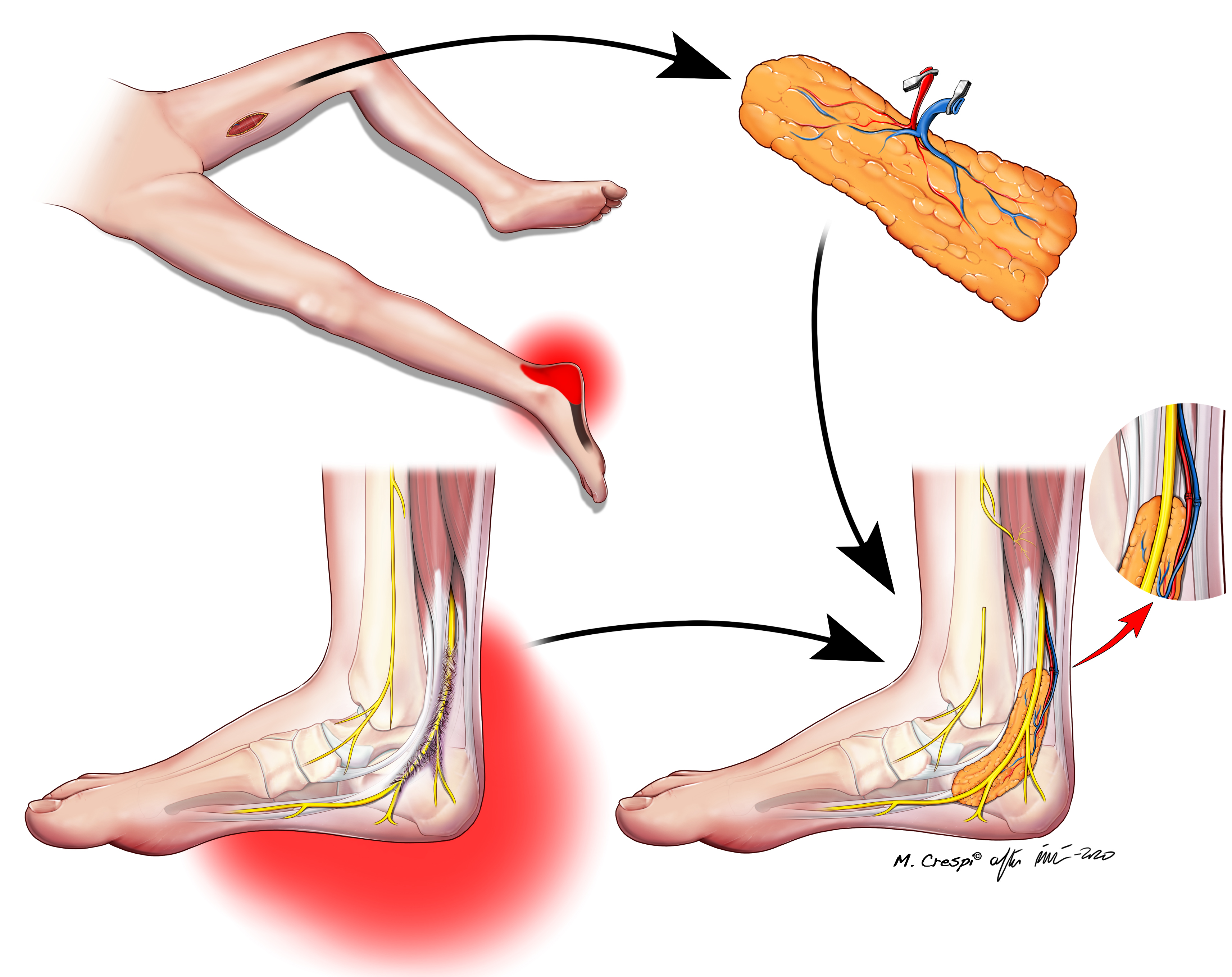Procedimiento microquirúrgico diseñado por el Dr. Piñal 