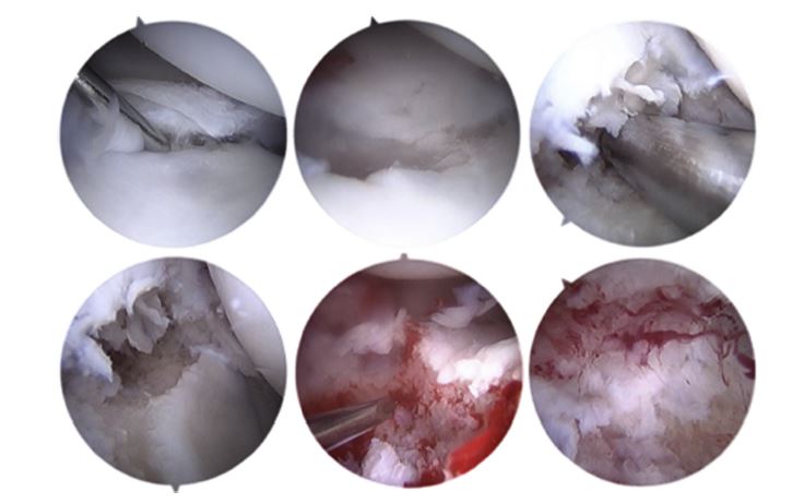 Midcarpal arthroscopy 