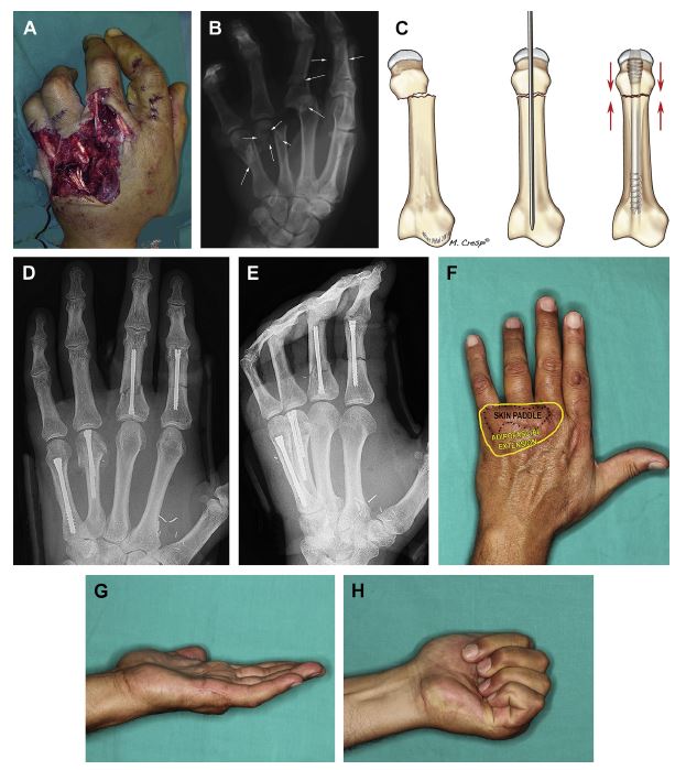 Multiple fractures managed with intramedullary cannulated screws fixation