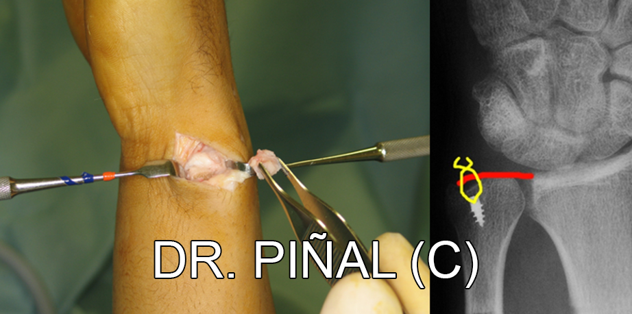 Removal of the styloid fragment and reinsertion of the TFC 