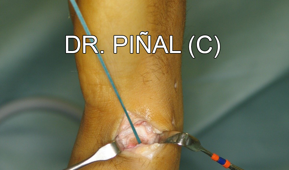 Exterior view of the suturing 