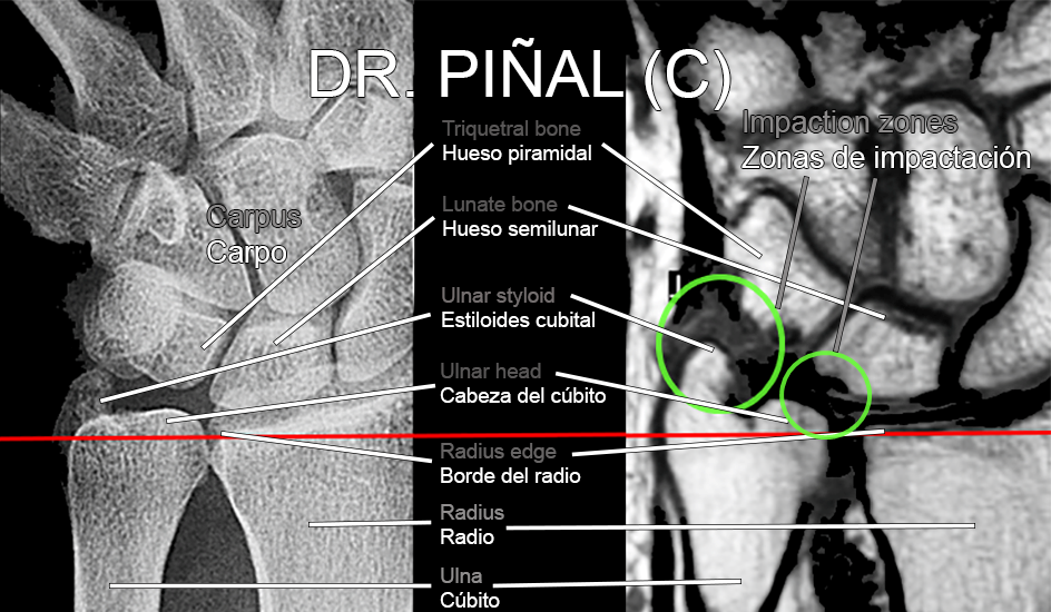 Ulnar impaction syndrome